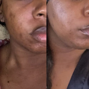 Amber Radiance (Hypigmentation Soap)